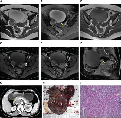 A Preliminary Exploration Using Imaging Methods to Predict the Possibility of the Recurrence of Serous Ovarian Cancer in Patients Undergoing Total Resection